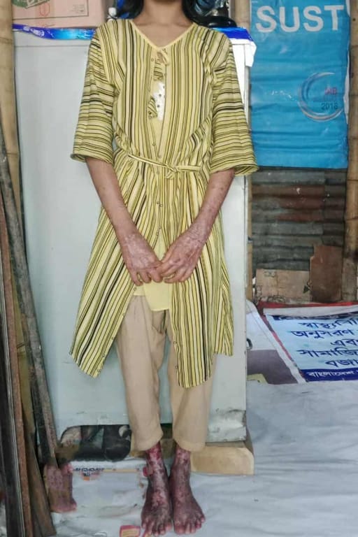 Jannatul is suffering from skin disease and cannot be treated due to lack of funds. Please pray for his recovery.