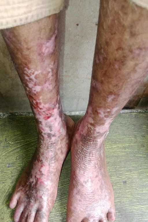Jannatul is suffering from skin disease and cannot be treated due to lack of funds. Please pray for his recovery.